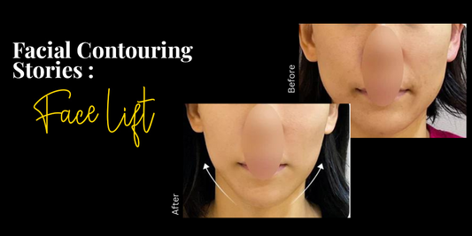 Facial Contouring Stories: Face Lift Before and After